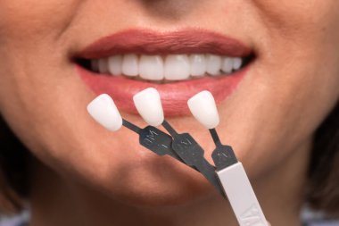 Beyazlatma konsepti. Diş bakımı, kaplamalar için implantlar. Mükemmel gülüşü olan güzel beyaz kadın diş sağlığı kliniğinde diş rengini seçiyor. Modern tıp.