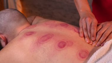 Hijama boş bardaklarının akupunkturunu kaldırdıktan sonra sırtında kırmızı izler var. Ventosa Geleneksel Masaj, Süpürge Temizleme Terapisi. Alternatif tıp.