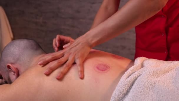 Piros Foltok Ember Hátán Miután Eltávolította Akupunktúrás Hijama Vacum Poharakat — Stock videók