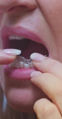 Alt çene dikey videosuna ortodontik hizalamalar uygulanıyor - 124k, 4k, 12 bit Braw Dikey Video