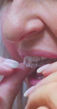 Üst Dişli Dikey Biçime Uygulamalı Diş Hizalama Sistemi Temizle