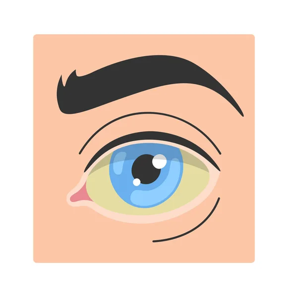 Geelzucht Human Eye Disease Vector Illustratie — Stockvector