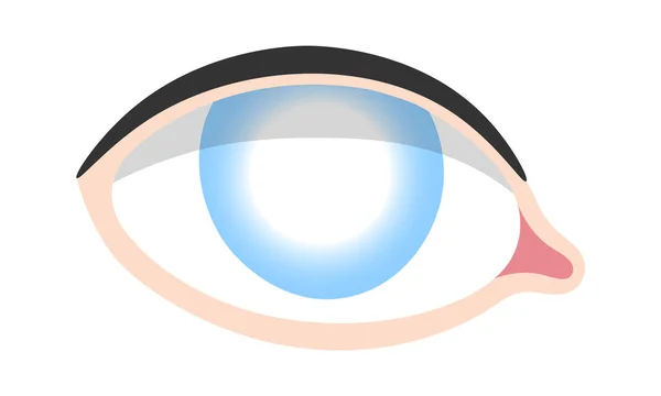 Katarakt Vektorillustration Für Menschliche Augenkrankheiten — Stockvektor