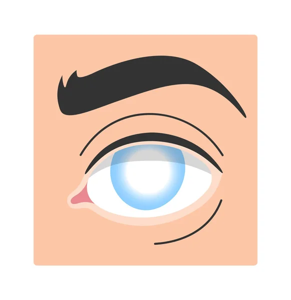 Illustration Vectorielle Maladie Oculaire Humaine Cataracte — Image vectorielle