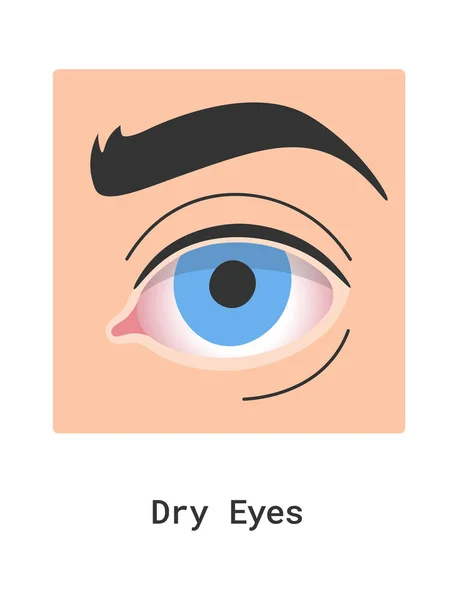 Vektor Illustration Für Trockene Augen — Stockvektor