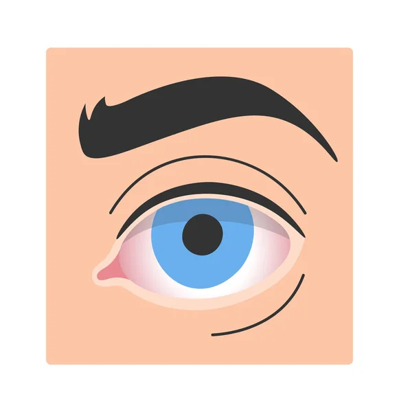 Векторная Иллюстрация Заболеваний Сухих Глаз — стоковый вектор