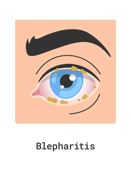 Blepharitis Human Eye Disease Vector Illustration — Stock Vector