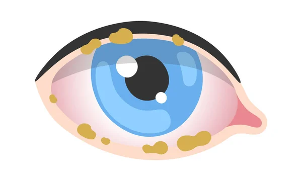 Blefaritis Enfermedad Ocular Humana Vector Ilustración — Archivo Imágenes Vectoriales