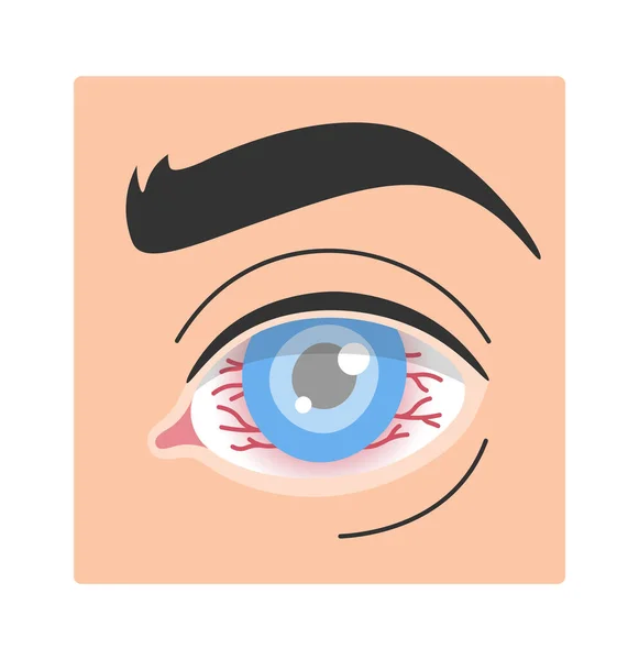 Corneal Herpes Parenchymal Eye Disease Vector Illustration — Stock Vector