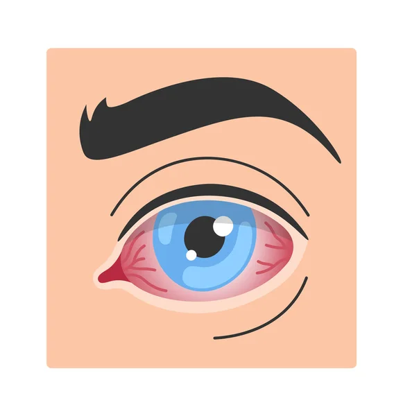Bacterial Conjunctivitis Eye Disease Vector Illustration — Stock Vector