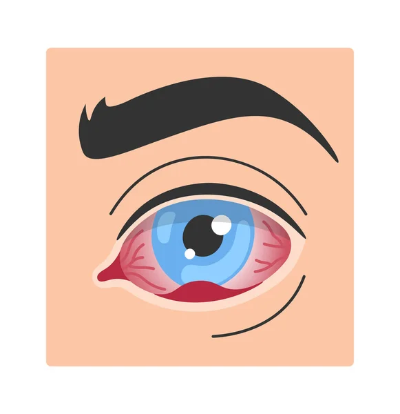 Stye Human Eye Disease Vector Illustration — Stockvektor