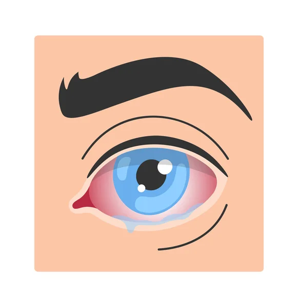Keratitis Human Eye Disease Vector Illustration — Stock Vector