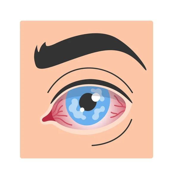 Corneal Herpes Epithelial Eye Disease Vector Illustration — Stockvektor