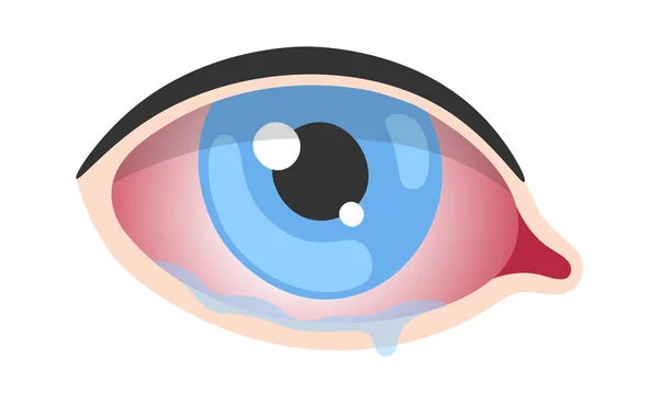 Queratitis Enfermedad Ocular Humana Vector Ilustración — Vector de stock