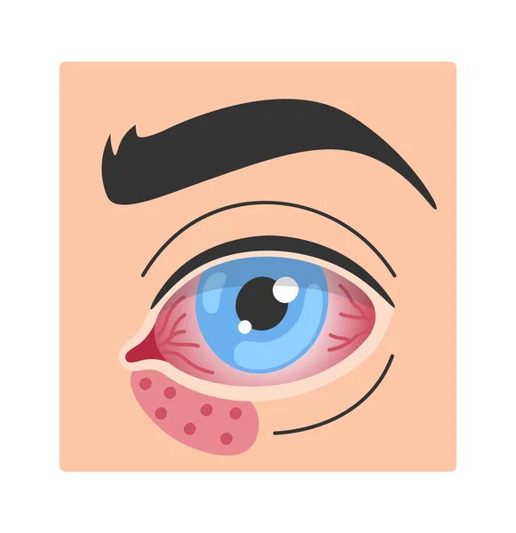 Ilustração Vetor Doença Ocular Infecção Herpes Simplex — Vetor de Stock