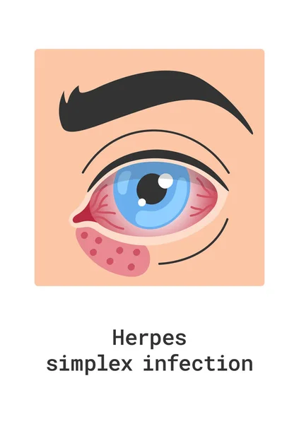 stock vector Herpes Simplex Infection Eye Disease Vector Illustration