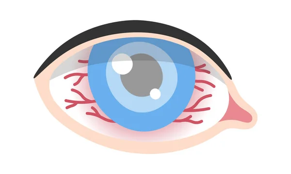 角膜ヘルペス 両眼疾患ベクトルイラスト — ストックベクタ