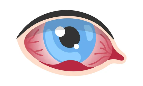 Stye Human Eye Disease Vector Illustration — Stock Vector