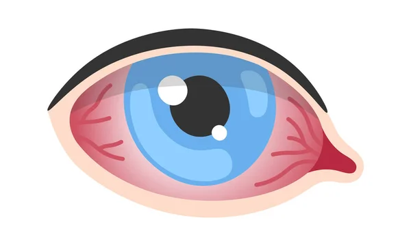 Bakterielle Konjunktivitis Augenkrankheit Vektor Illustration — Stockvektor