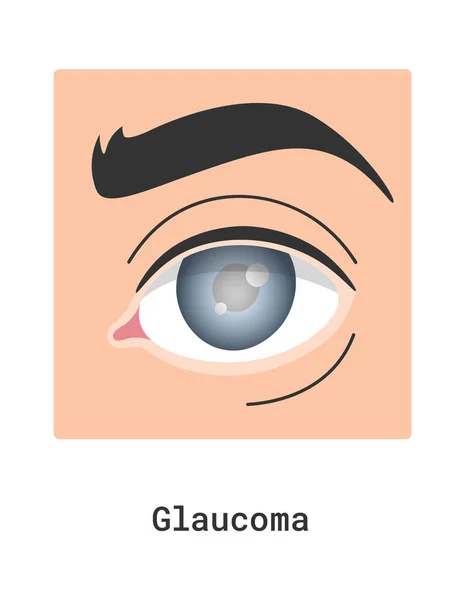 Glaucoma Human Eye Disease Vector Illustration — Stock Vector