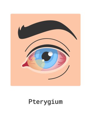 Pterygium İnsan Gözü Hastalığı Vektör İllüzyonu