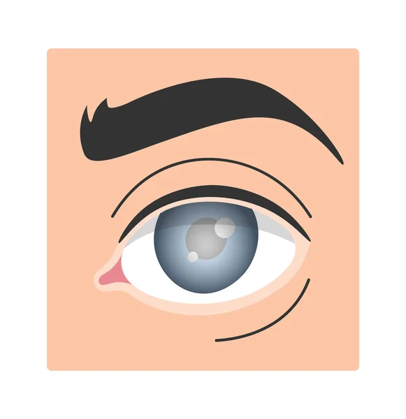 Ilustrasi Vektor Mata Manusia Glaucoma - Stok Vektor