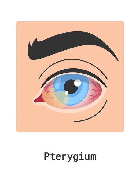 Pterygium Human Eye Disease Vector Illustration — Stock Vector