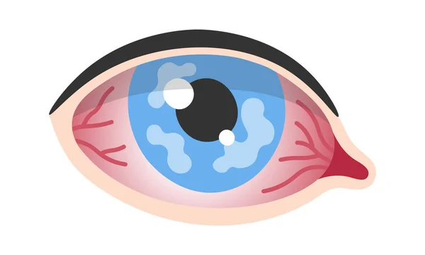 Corneal Herpes Epithelial Type Eye Disease Vector Illustration — Stock Vector
