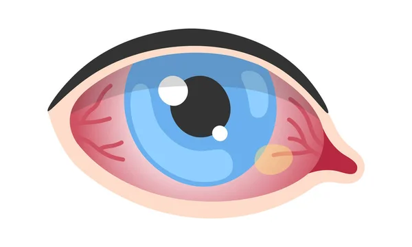 Pinguecula Enfermedad Ocular Humana Vector Ilustración — Vector de stock