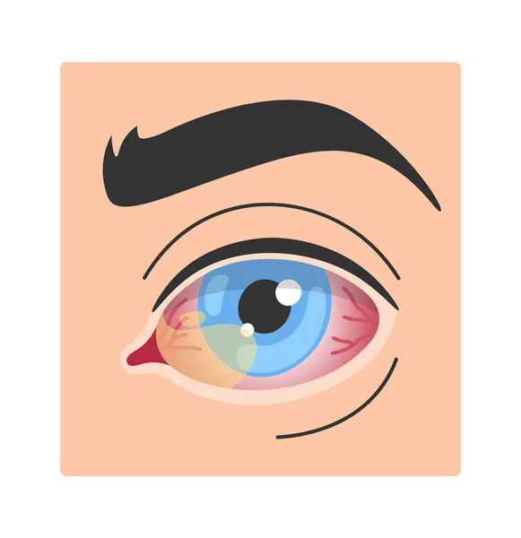 Pterigión Enfermedad Ocular Humana Vector Ilustración — Vector de stock