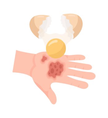 Yasak Cilt Yanığı Tedavi Vektörü İllüstrasyonu