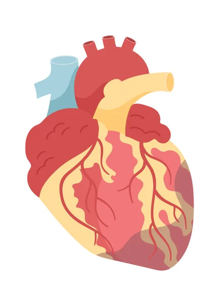 Ilustração Vetorial Doença Cardíaca Coronária — Vetor de Stock