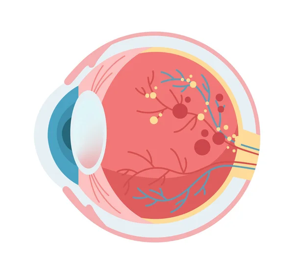 Eye Damage Disease Vector Illustration — Stock Vector