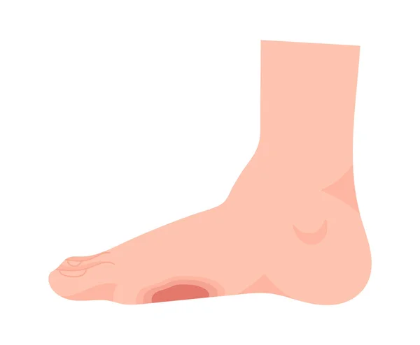 Foot Ulcer Disease Vector Illustration — Stock Vector