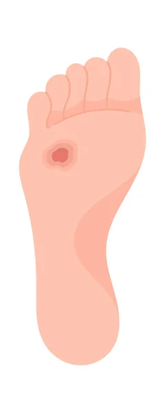 Deep Ulcer Foot Disease Vector Illustration — Stock Vector