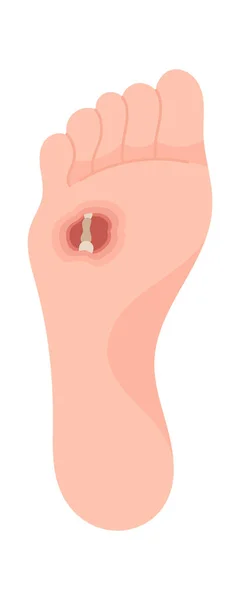 Absces Osteitis Foot Disease Vector Illustration — Stockový vektor