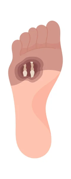 Gangrene Forefoot Disease Vector Illustration — Stock Vector