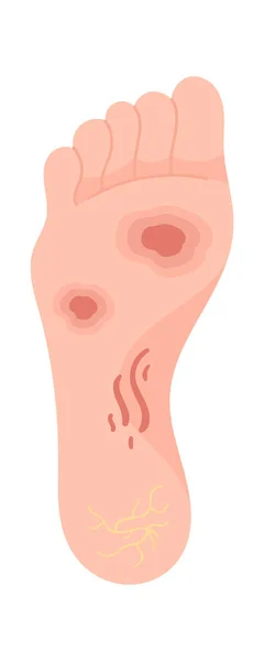 Vektorová Ilustrace Onemocnění Lidských Nohou — Stockový vektor