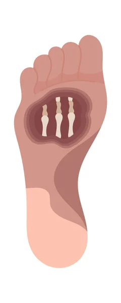 Celý Foot Gangrene Disease Vector Illustration — Stockový vektor