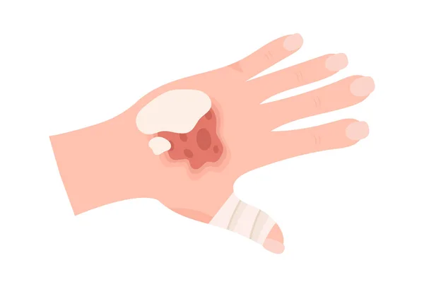 Primeiros Socorros Bandaged Mão Vetor Ilustração — Vetor de Stock