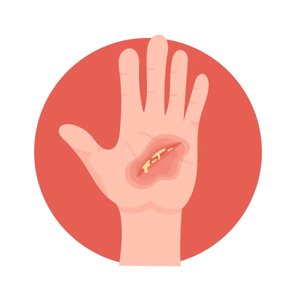 Anzeichen Einer Infektion Der Hand Wundvektor Illustration — Stockvektor
