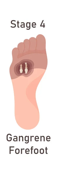 stock vector Gangrene Forefoot Disease Vector Illustration