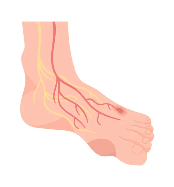 Vektorová Ilustrace Onemocnění Lidských Nohou — Stockový vektor