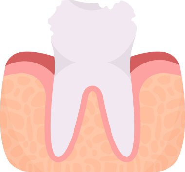 Çürük Diş Problemi Vektörü İllüstrasyonu