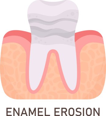 Enamel Erozyon Diş Problem Vektörü İllüstrasyonu
