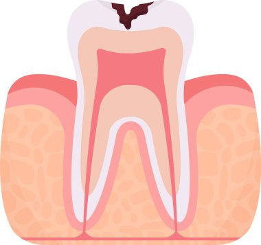 Deep Caries Problem Vektörü İllüstrasyonu