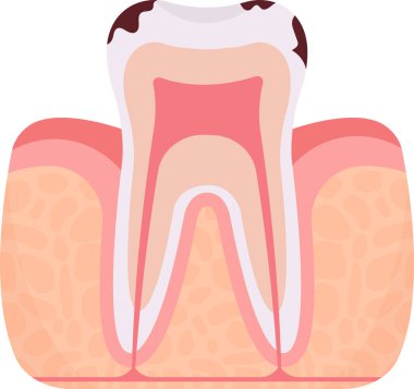 Caries Diş Problemi Vektörü İllüstrasyonu