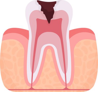Pulpitis Tooth Problem Vektörü İllüstrasyonu