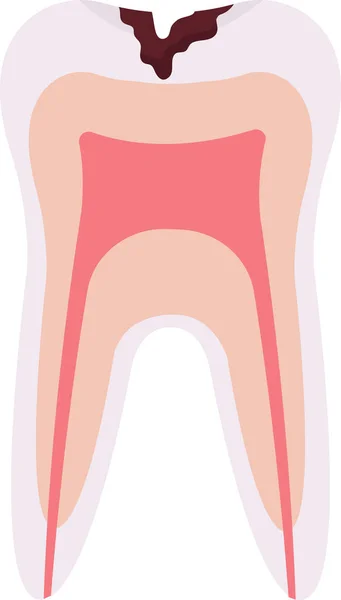 Caries Profunda Problema Dental Vector Ilustración — Archivo Imágenes Vectoriales