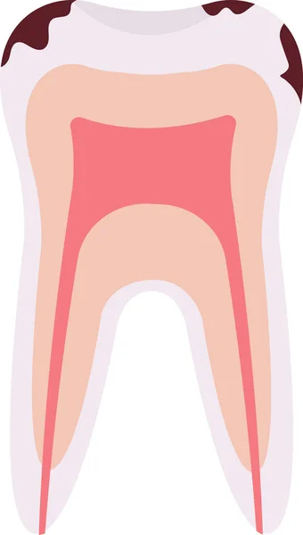 Illustrazione Vettoriale Del Problema Dentale Della Carie — Vettoriale Stock